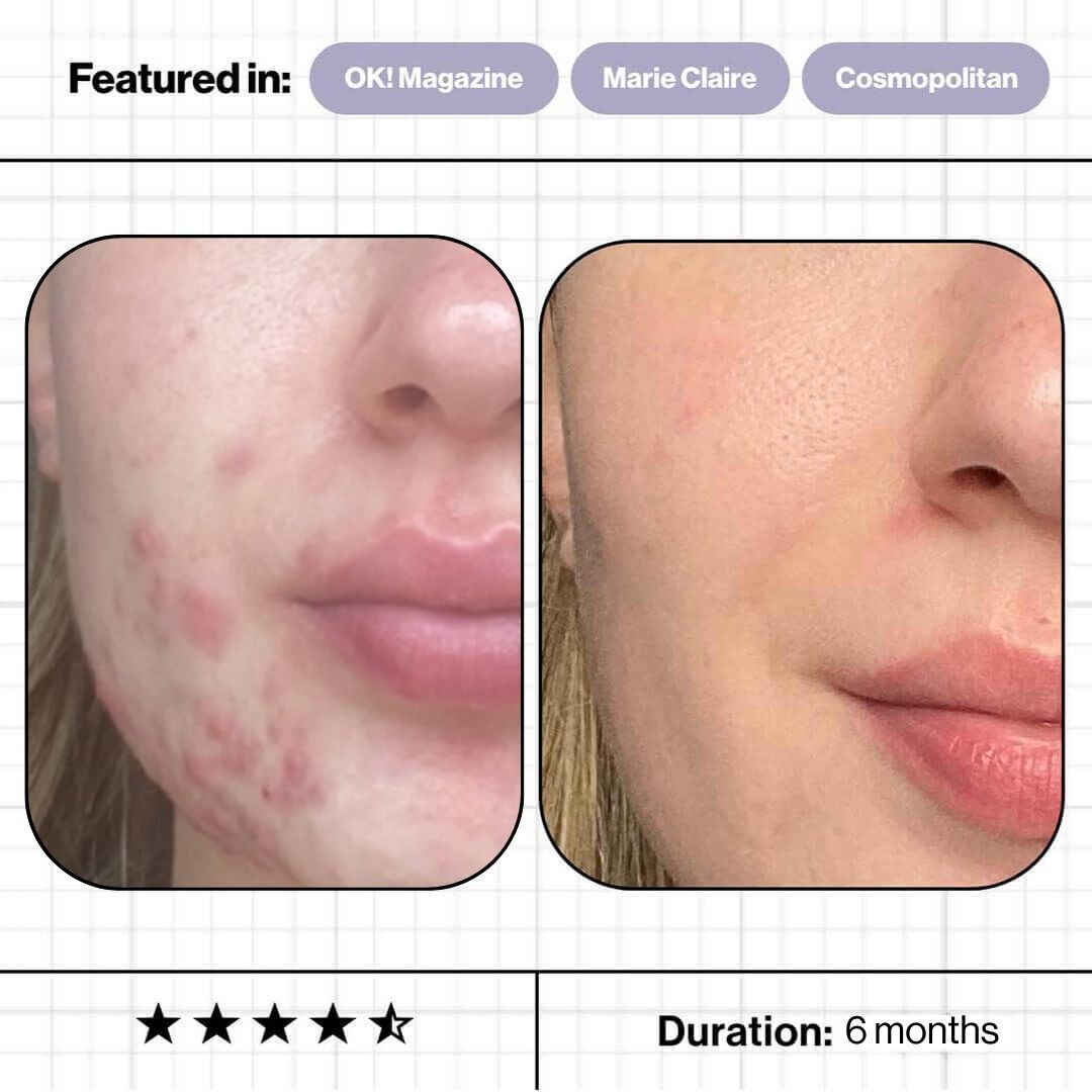 Skin Accumax 14 week reset kit
